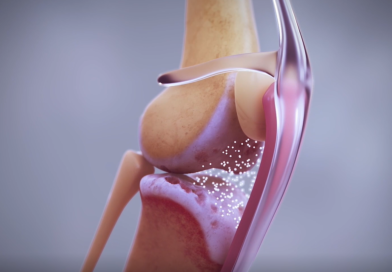 Osteoartitida: léčba bolesti pomocí monoklonálních protilátek